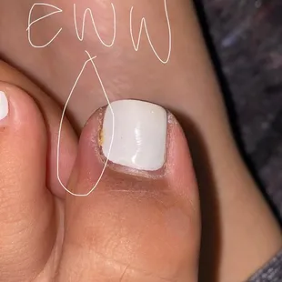Left toe infection with puss