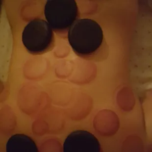 If you've never had cupping done be warned it looks like an octopus attacked u for a few days.