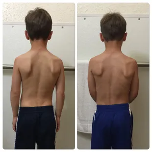 Scoliosis and Nerve Decompression Therapy!