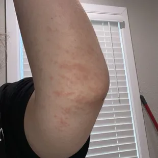 Rash or possibly chemical reaction. Be aware not sure how sanitary that bar is.