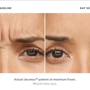Actual Jeuveau patient at maximum frown. Results may vary.
 https://alamodemedspa.com/