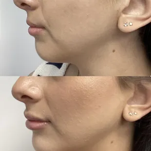 Reveal your perfect symmetry: Before and after lip and chin filler, witness the harmonious transformation that enhances natural beauty.
