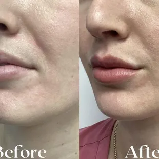 Transforming lips and defining chins with the artistry of filler injections.