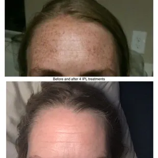 IPL treatments for freckle removal after 4 treatments.
