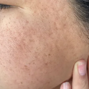 After 4 microneedling treatments