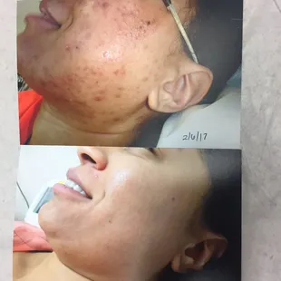 I am beyond satisfied with the results! I recommend Leta to everyone looking to get rid of their problem skin! She&apos;s amazing!