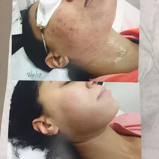 I&apos;ve been seeing Leta every 6-8 weeks for treatments and the pictures speak for themselves!
