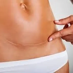 Scar revision therapy
