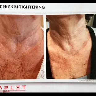 Scarlet RF used for chest skin tightening