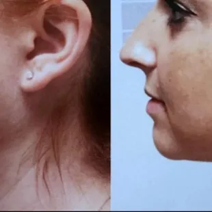 Agnes RF used for double chin fat reduction