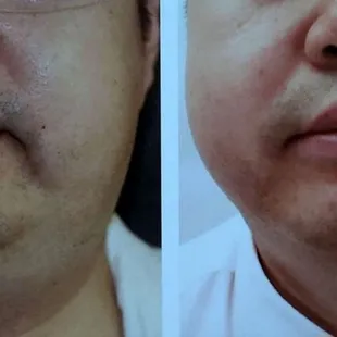 Agnes RF used for fat emulsification of double chin and face contouring