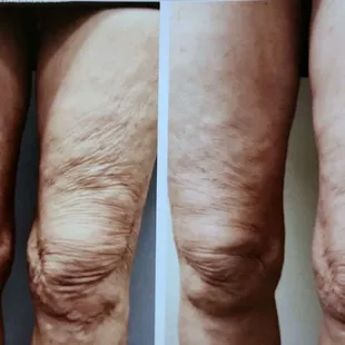 Scarlet RF used for thigh skin tightening