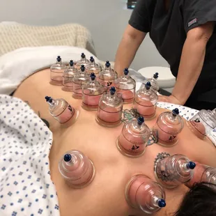 Cupping is for many purposes, including to help with pain, inflammation, blood flow, relaxation and well-being, and deep-tissue massage.