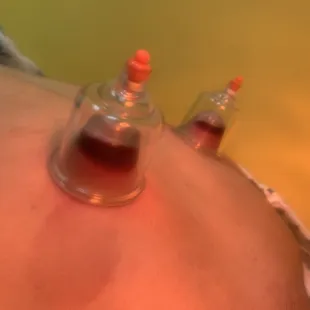 Cupping older than any western medical science