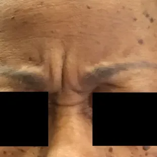 W. Before Botox