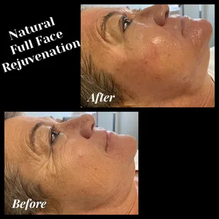 Natural Full Face Rejuvenation!