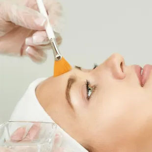 Chemical Peels