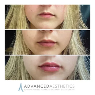 Before and after dermal fillers