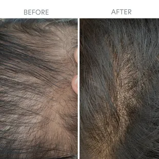 Before and after PRP Hair Restoration Treatment