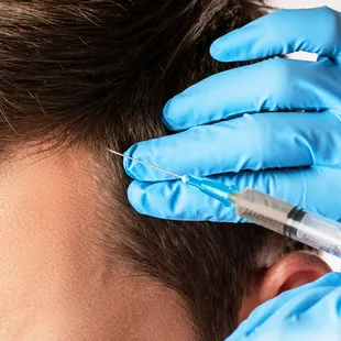 PRP Hair Restoration