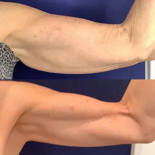Body Contouring &amp; Muscle Tightening