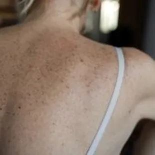 Advanced Dermatology &amp; Skin Cancer Specialists - woman freckled back