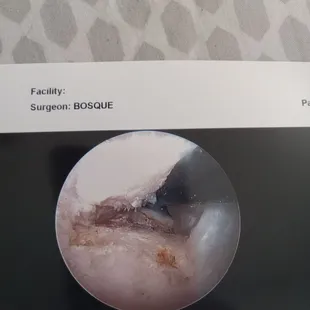 Inside my shoulder before surgery.