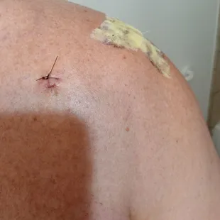 Sutures after surgery.