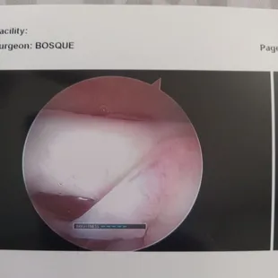 Inside my shoulder after surgery.