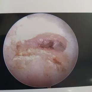 Inside my shoulder before surgery.