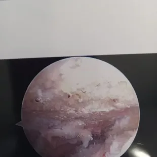 Inside my shoulder before surgery.