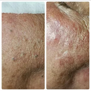 Before and after extractions