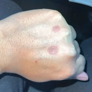 a person's hand with red spots