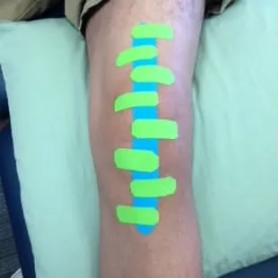 We Use Kinsesio tape to loosen scars