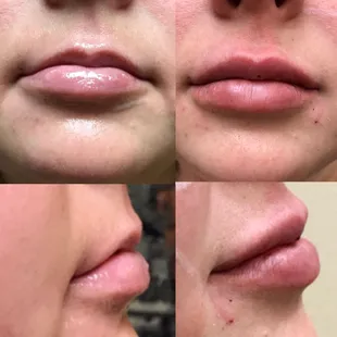 Before and after, less than one syringe of Juvederm! Unedited pictures, swelling and bruising is normal.