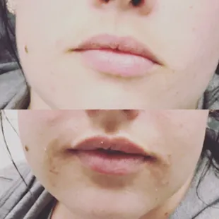 1/4 syringe of Refyne to correct asymmetry. No added volume to the other side.