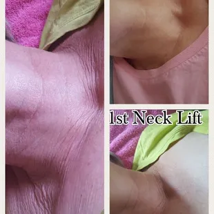 Immediate Neck Lift! Instant and lasting results. Vegan products and medical grade equipment.