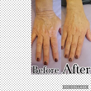 Anti-Aging Ultrasonic Peel