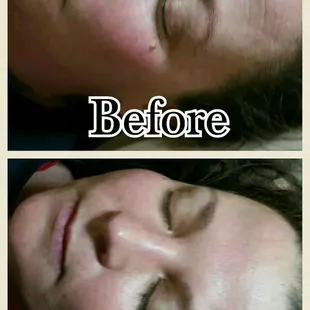Results of 1 Ultrasonic facial. Instant wrinkle reduction, reduction in redness, cleans pores, tones, firms and tightens immediately!