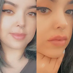 I wanted my lip shape to stay pretty much the same but with added volume and I got exactly that. Dr. Lam used Juvederm XC 1ml