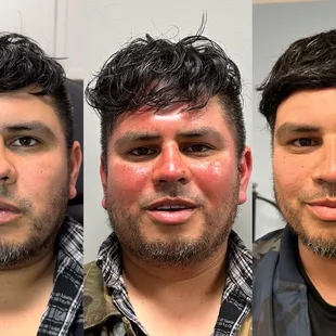 Left: Before PRP Microneedling
Middle: Right After PRP Microneedling
Right: 24 hours After PRP Microneedling