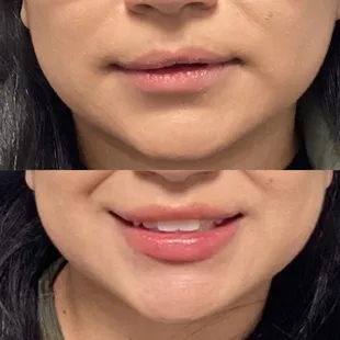 After one session of Lip Fillers