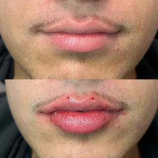 1 Syringe of a Lip Filler Treatment