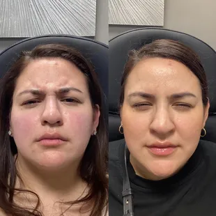 3 weeks after BOTOX treatment!