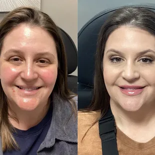2 weeks after a Lip Filler &amp; Eyebrow Lift