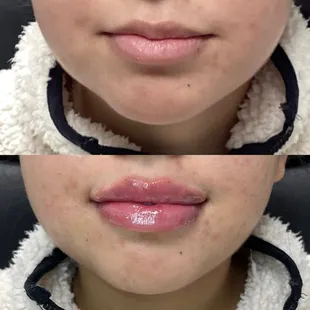 Before &amp; after Lip Fillers.  Minimal bruising is completely normal. It will take 2-4 weeks to fully heal depending on the person.