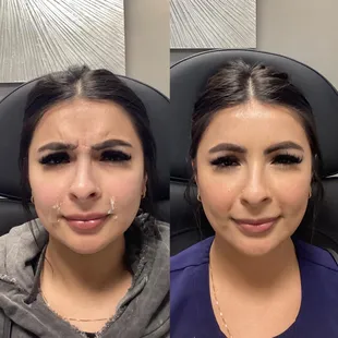 3 weeks after BOTOX treatment!