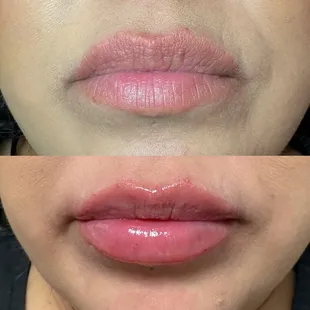 Results right after a Lip Filler Treatment
