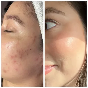 Before &amp; After Results. Photos taken 10 months apart with home care, peels and treatments.