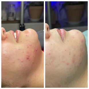 Photos taken 12 days apart with Face Reality home care and a facial with a mild peel.